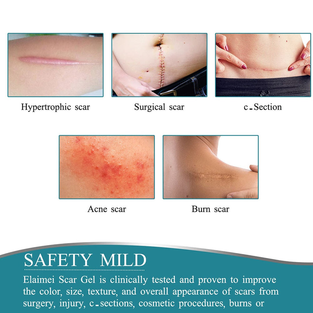Silicone Scar Tape Roll For Improved Appearance Texture And Size Of Scars - Image 6